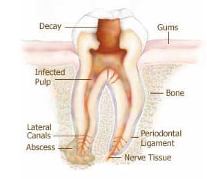 A Deep Infection